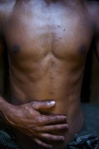 Elaich Mia, 22 was shot by the Indian BSF 25 times while he, Ashraful Islam and Shona Mia were extracting stones at the Kalidar Stone Quarry in Companyganj, Sylhet. He had to be confined in the hospital for 8 days. These scars are the remainders of that brutal evening.